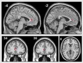 Participants with major depression showed increased activity in left rostral anterior cingulate cortex following psychological therapy - Sankar et al, 2018