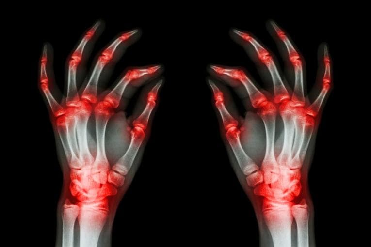 Representation of joint inflammation on xray